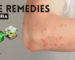 Home Remedies for Urticaria