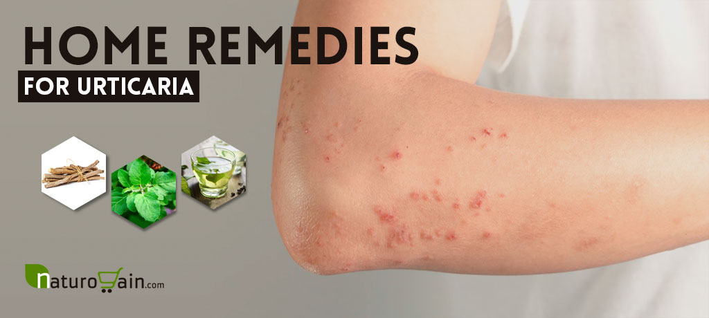 Home Remedies for Urticaria