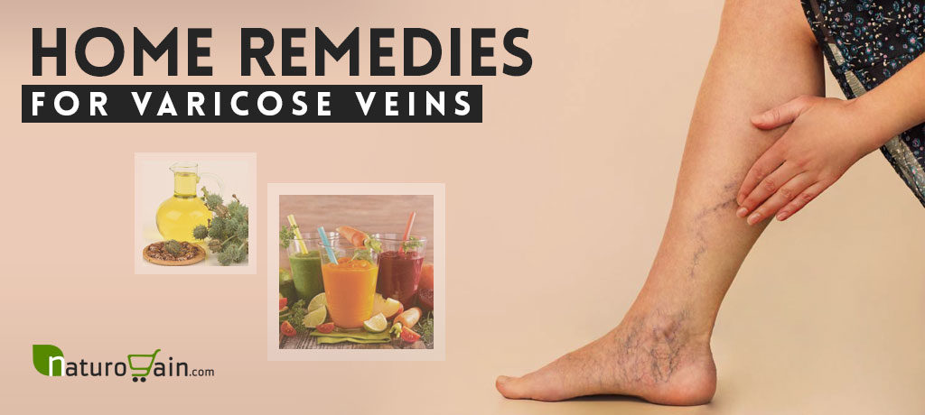 Home Remedies for Varicose Veins