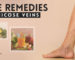 Home Remedies for Varicose Veins