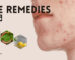 Home Remedies for Zits